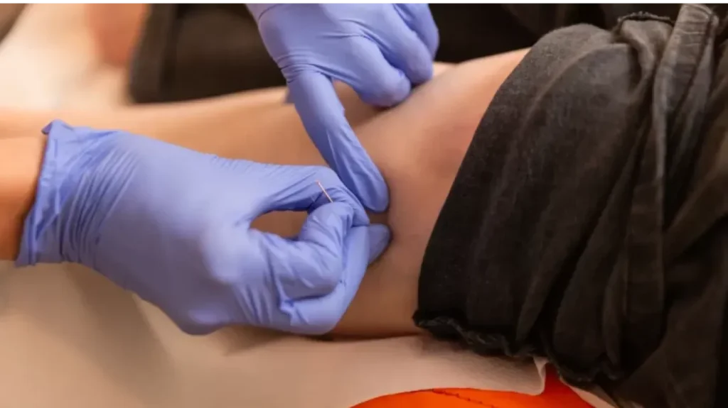Physiotherapy Sunshine Services - Dry Needling | Your Story Physiotherapy