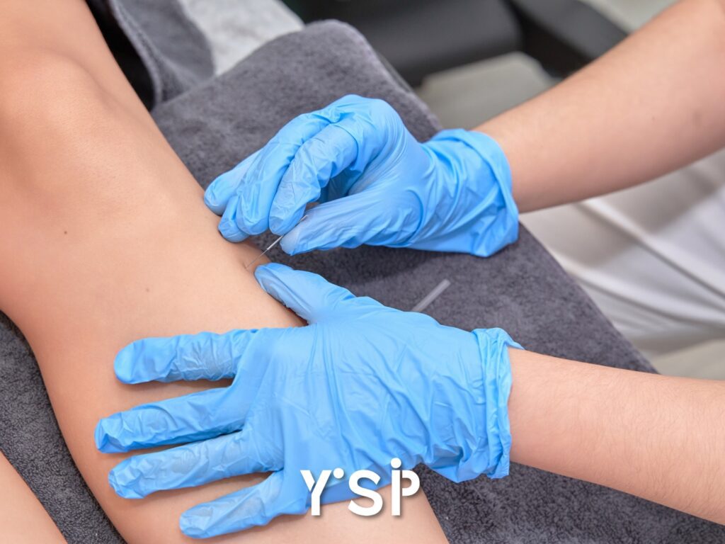 Melbourne Physiotherapy Dry Needling | Your Story Physiotherapy